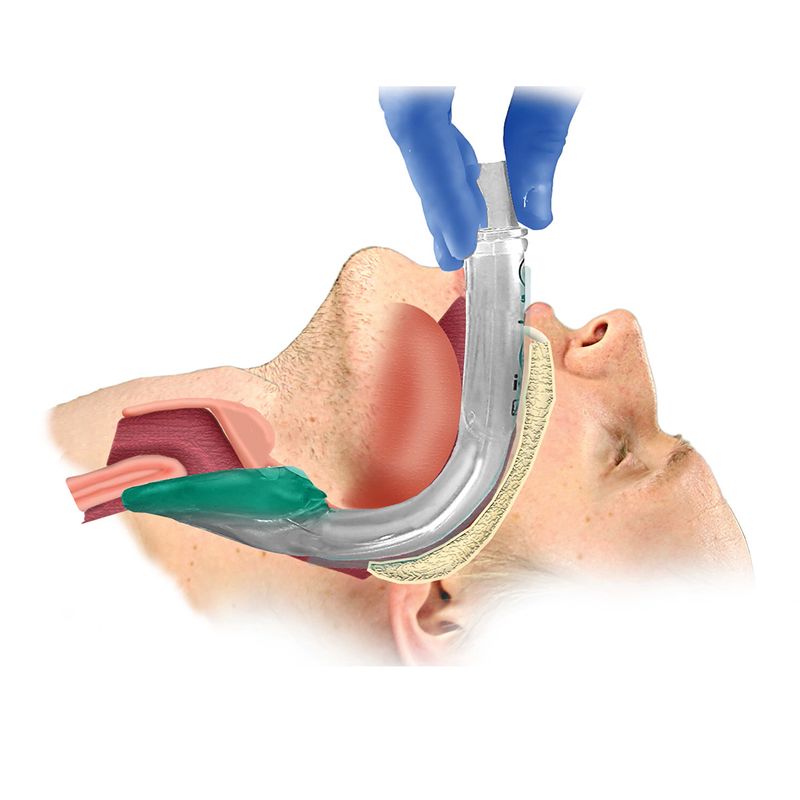 Larynxmaske i-gel kit str 3